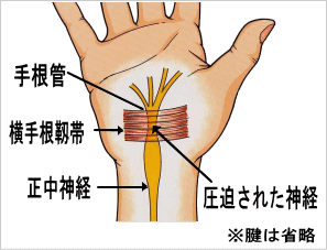 手 根 管 症候群 これ で シビレ 痛み が 消え た