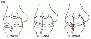 野球肘（離断性骨軟骨炎）　遊離体の図